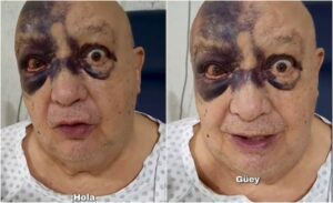 Luis de Alba preocupa tras accidente; reaparece con el rostro cubierto de hematomas